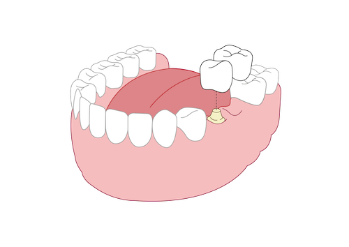 Conventional Fixed Partial Denture