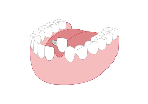 This image shows how the artificial tooth is supported by one adjacent tooth. However, it is more likely that it will be supported by two adjacent teeth.
