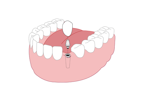 Dental Implants - 1